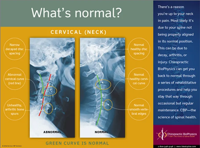 Normal vs abnormal spinal alignment showing the importance of proper spinal curves